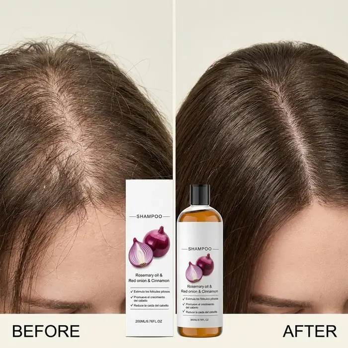 Shampoo à l'huile de romarin et d'oignon rouge anti-chute de cheveux