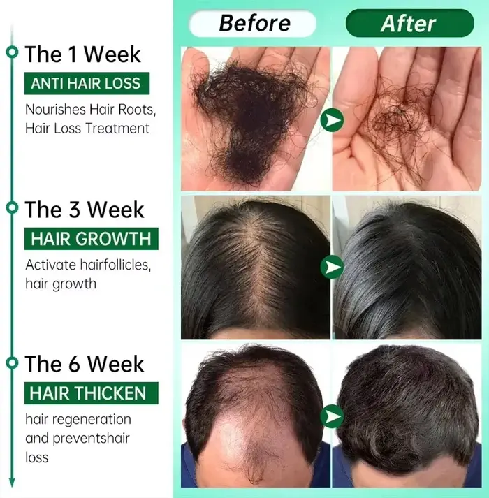 Sérum de croissance des cheveux pour hommes et femmes