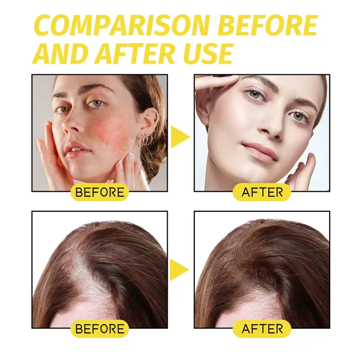 Huile essentielle pour la croissance des cheveux. Répare efficacement les symptômes de calvitie et de perte