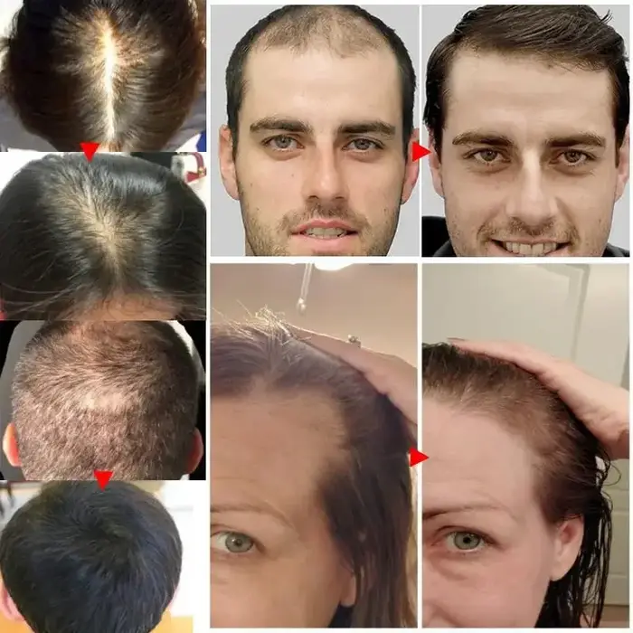 Sérum de croissance rapide des cheveux pour femmes et hommes