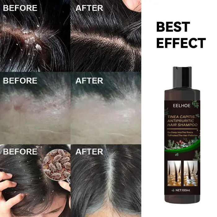 100ml Eelhoe shampooing Anti-démangeaisons