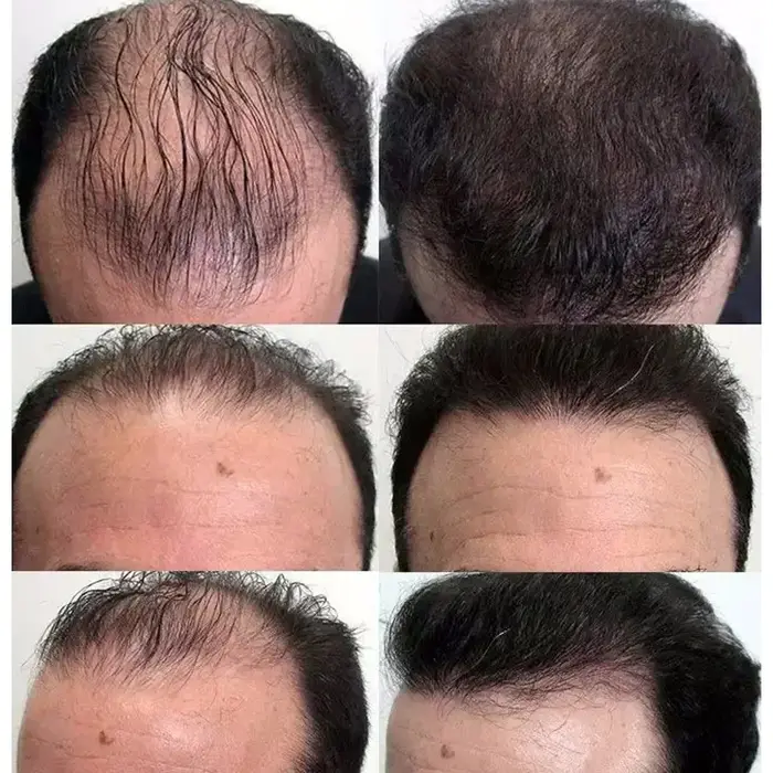 Sérum de croissance rapide des cheveux