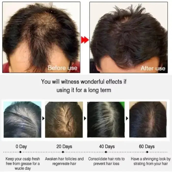 Sérum de croissance des cheveux pour hommes et femmes