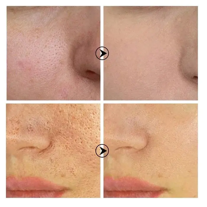 Skin Bergamo | Pore Refining Resurfacing